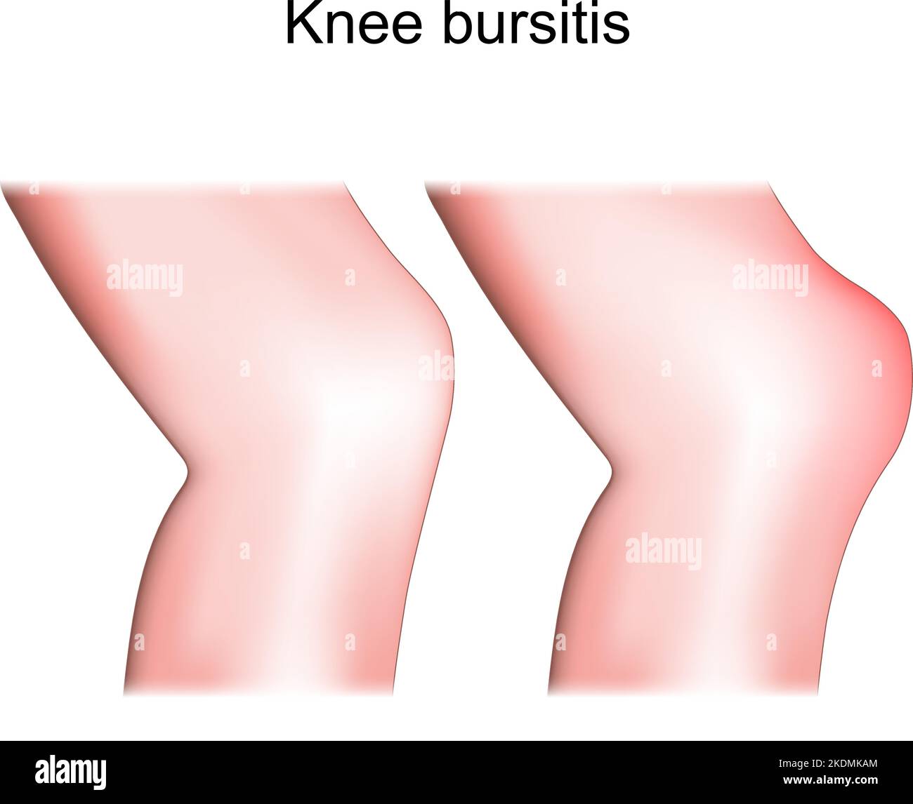 Bursite De Genou Bursite De Prepatellar Différence Et Comparaison De Larticulation Saine Et 