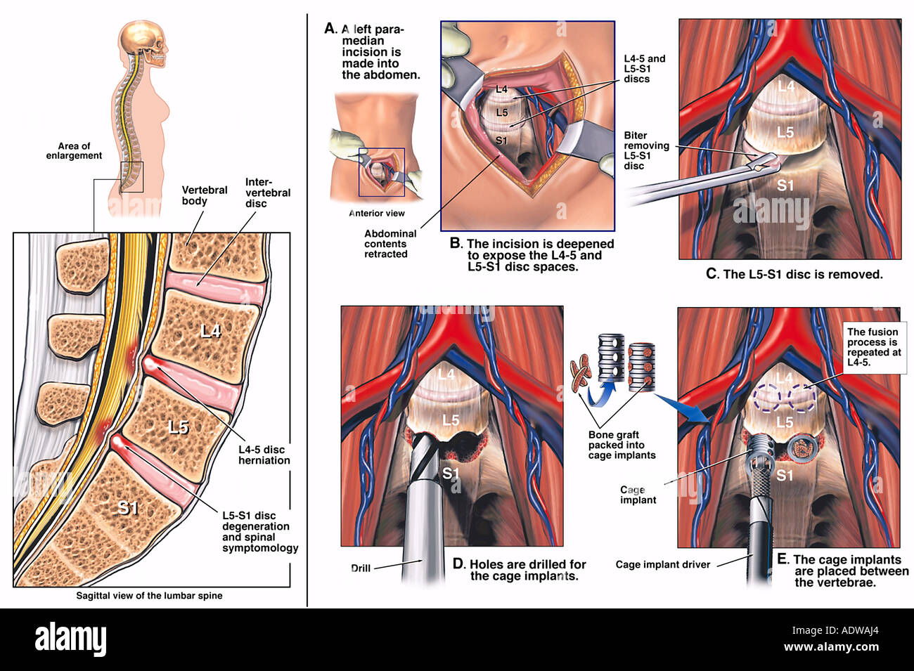 La Chirurgie De La Colonne Vertébrale L4 5 Et L5 S1 Procédure De Fusion Vertébrale Lombaire