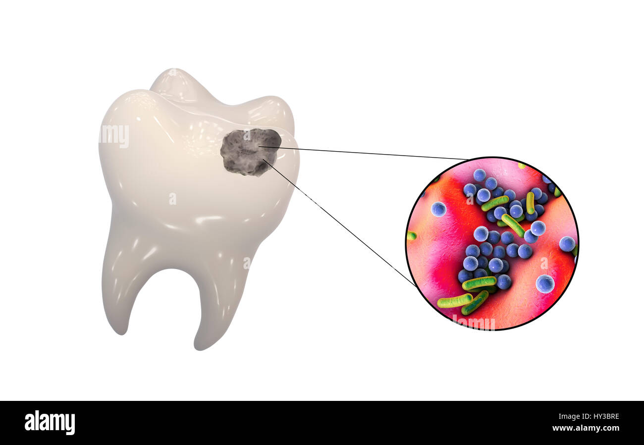 La Carie Dentaire Illustration Dordinateur Dune Dent Avec Une Cavité Et Une Vue Rapprochée De 